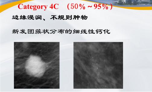 乳腺结节bi-rads分级依据,国内乳腺结节bi-rads分级标准