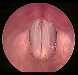 鼻腔发声的训练,矫正喉发声训练