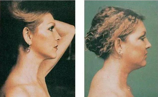 平背去除富贵包,有富贵包的话怎样可以减掉富贵包