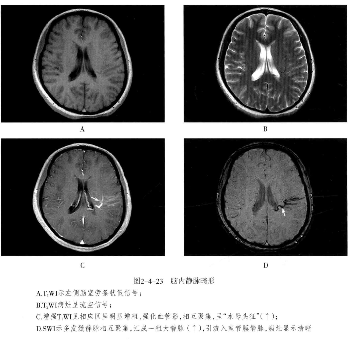 颅内血管周围间隙的影像鉴别,颅脑血管源性疾病影像诊断