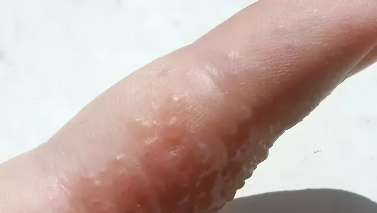 痒痒痒!身上出现这种小水疱,千万别戳破