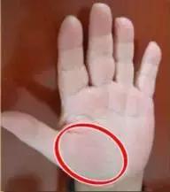 手的健康识别,看手识病疾病自测