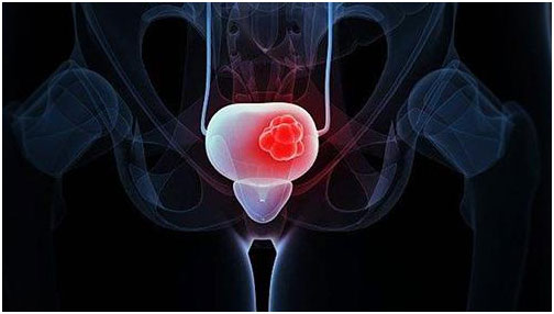 尿频尿急伴有血尿是怎么回事,尿频尿急血尿是膀胱癌吗