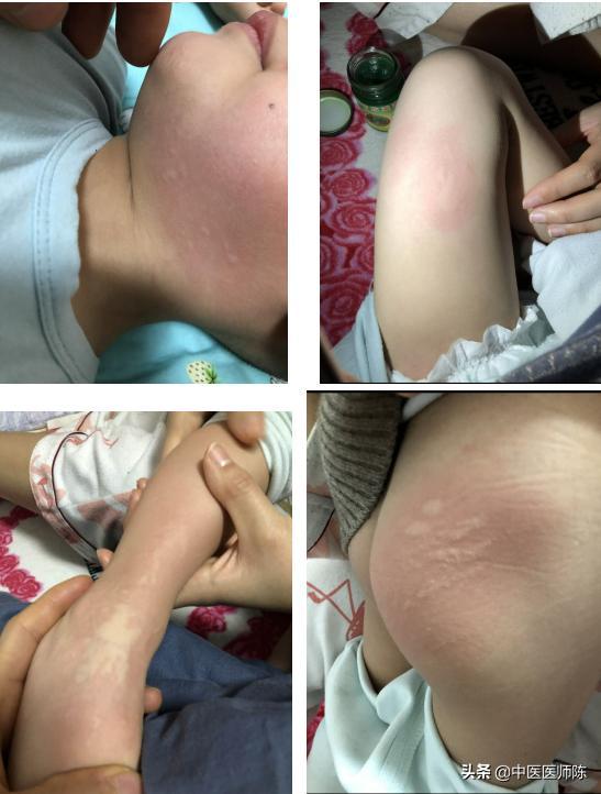 2岁半小儿*麻疹荨**久治不愈中途又发生医患误会，结局不可思议