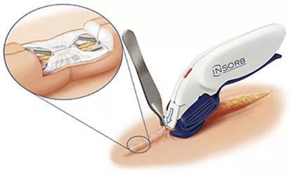 蚂蚁和羊肠是怎么把你和你“缝”在一起的?