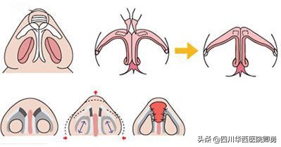 耳软骨加鼻中隔隆鼻价格多少,鼻中隔软骨隆鼻3d动画演示