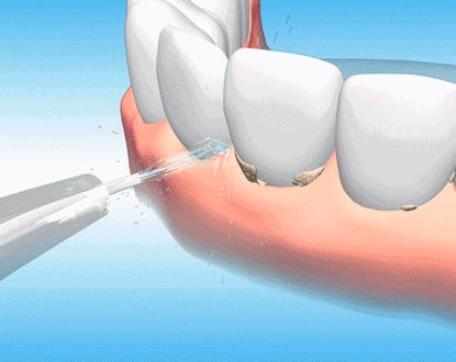 成人肠胃不好口臭除根的最好办法,成人口臭是怎么回事怎么治疗