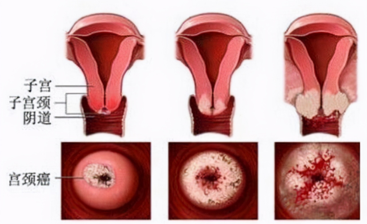 女人宫颈糜烂会影响月经量少吗,宫颈糜烂会对女性有哪些影响