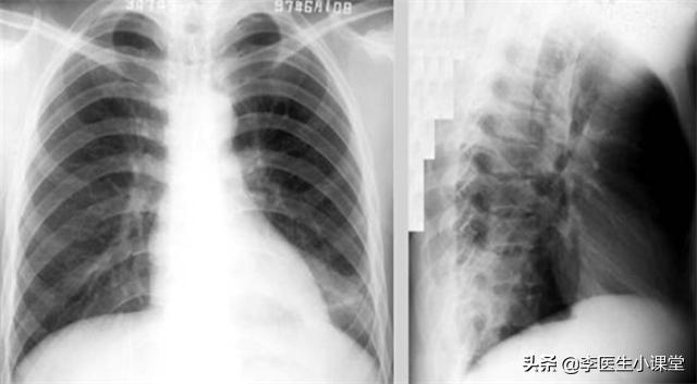 阿莫西林颗粒能不能乱吃,阿莫西林别乱吃只对四种病有作用