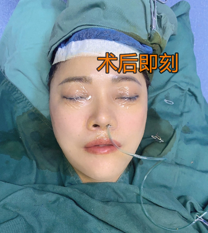 内窥镜无痕拉皮术,内窥镜脸部拉皮到底有多厉害