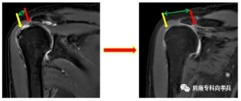 肩袖撕裂能自愈吗,肩袖撕裂康复训练