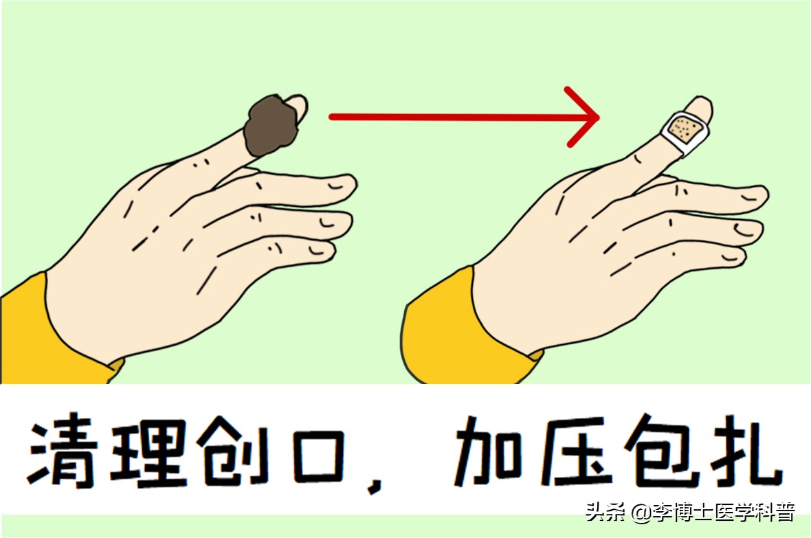 手外伤撕裂恢复最佳方法,手外伤的急救处理与断指的保存