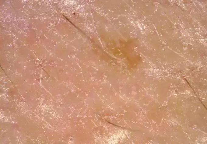 怎样改善油性皮肤问题,怎样改善油性皮肤长痘