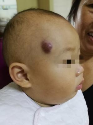 混合型血管瘤的治疗办法,混合型血管瘤的最佳治疗方法