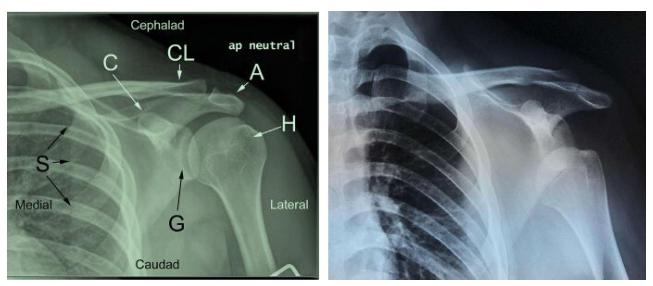 习惯性肩关节脱位怎么办,怎么检查肩关节是不是习惯性脱位