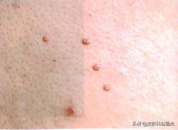 得了扁平疣如何锻炼身体,扁平疣是很严重的疾病吗