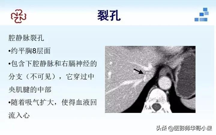 「精品课件」胸部膈肌的解剖及常见病变影像的表现
