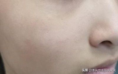 身上有几块白斑能被确诊白癜风,身上白色斑块怎么排除白癜风