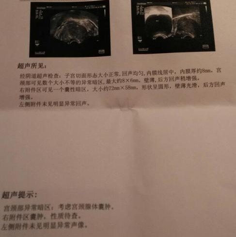 彩超已经显示卵巢囊肿怎么造成的,我最近感觉胸胀胀的怎么回事