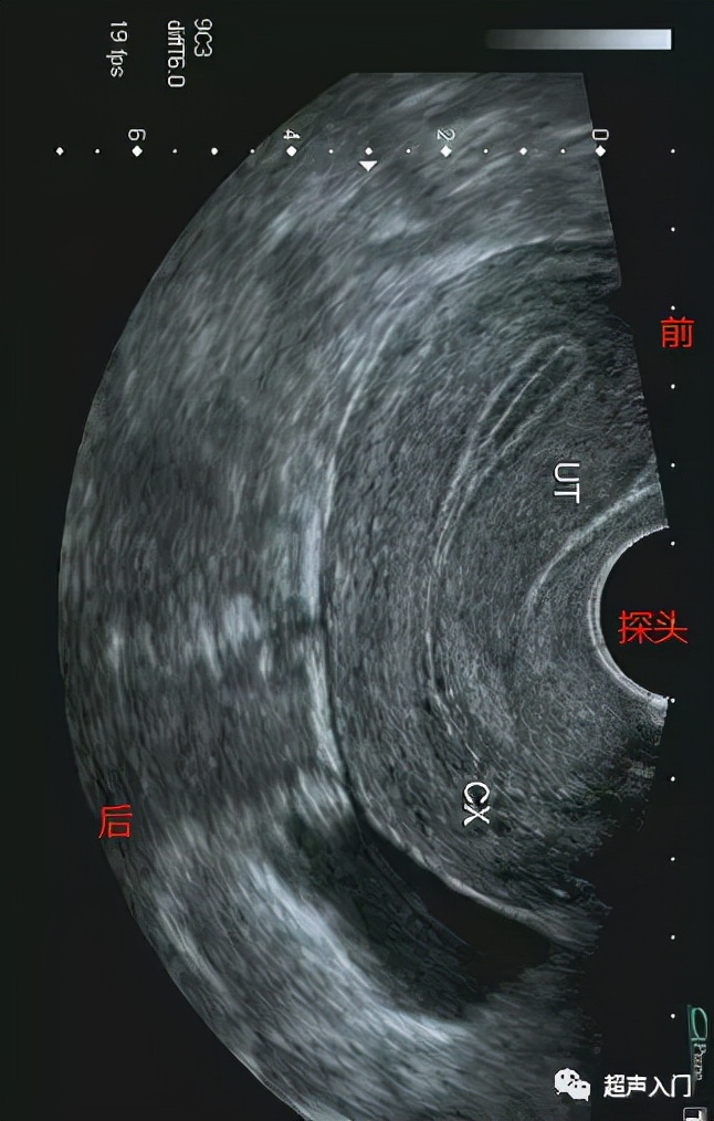 超声怎么分辨前后位子宫,超声如何区分子宫前后位