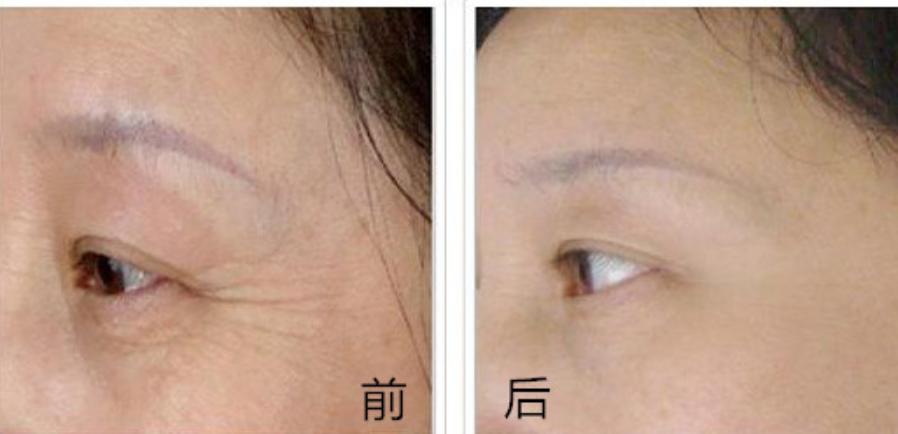 肉毒素和玻尿酸除皱哪个更实惠,如何选择肉毒素和玻尿酸注射除皱