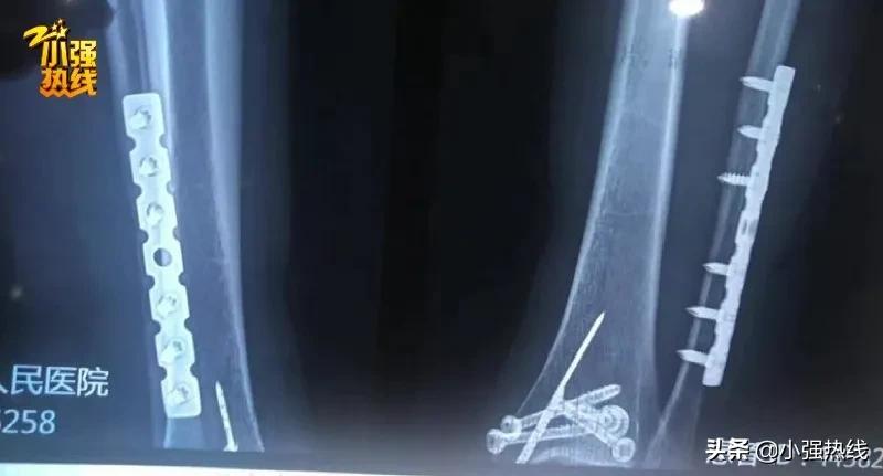 浙江女子出国游崴断脚踝拆钢板费用无法理赔