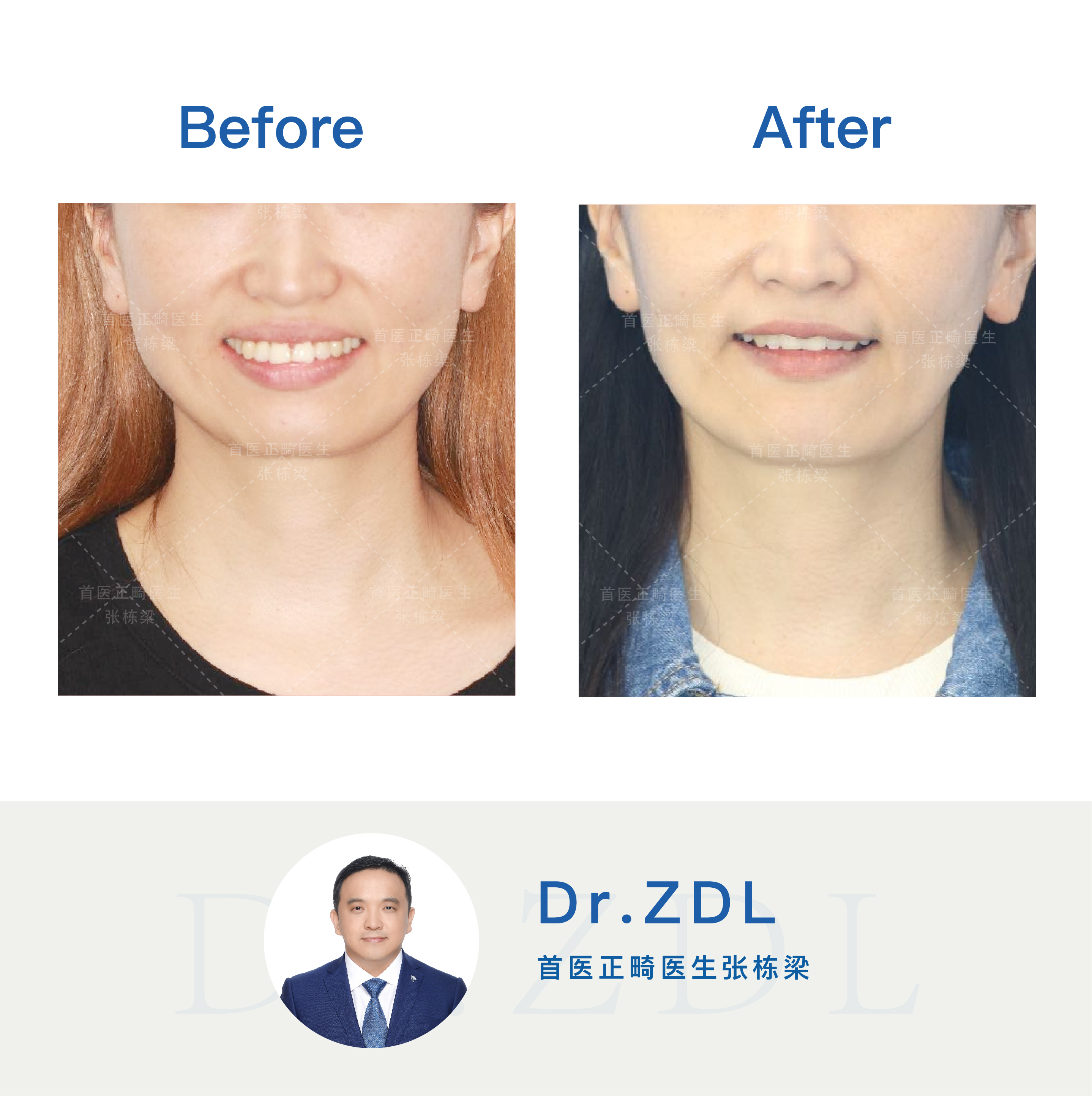 嘴突不做牙齿矫正后果,嘴突没有龅牙可以修复吗