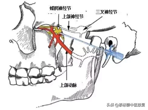 过敏性鼻炎针灸疗法穴位,鼻炎针刀