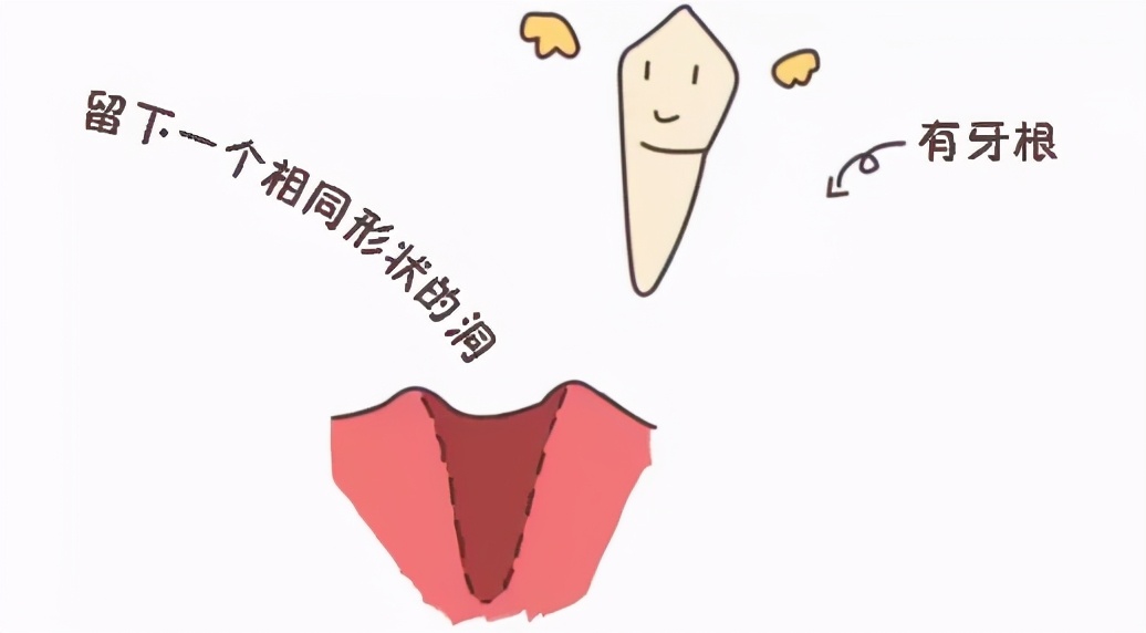 阻生牙拔牙后的牙洞愈合过程,智齿拔牙后牙洞愈合动画演示