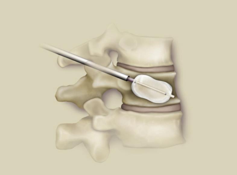 腰椎l4骨折保守治疗多久可以恢复,腰椎骨折手术还是保守治疗好