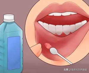 儿童口腔溃疡怎么治最快小妙招,嘴巴经常溃疡怎么预防