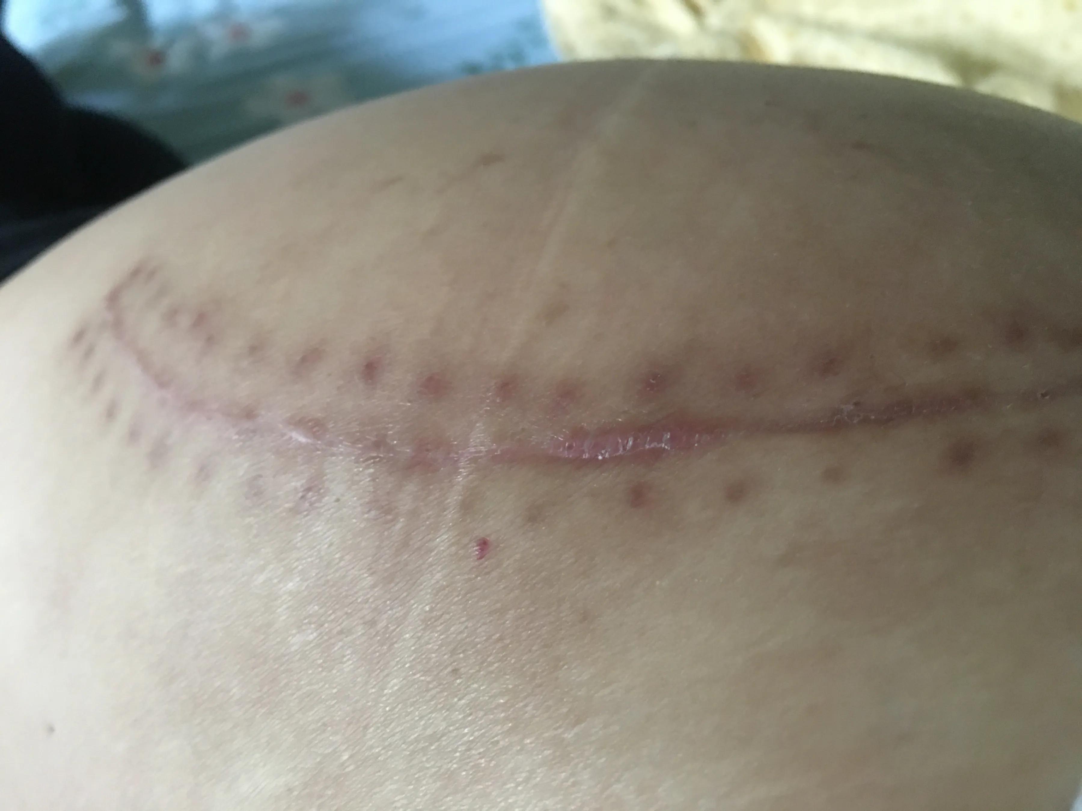 伤疤护理神器分享