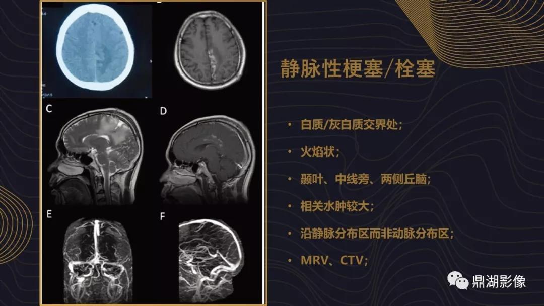 不简单|脑出血超详细学习笔记