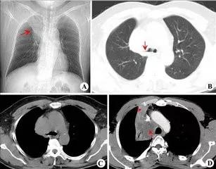 肺癌患者福音：肺癌已被“攻克”，联合疗法成为治疗肺癌潜力股