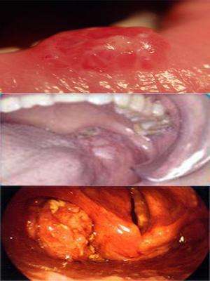 最全面的口腔溃疡治疗方法详解,怎么快速治愈严重口腔溃疡