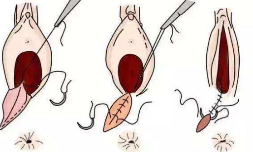 孕妇侧切伤口如何护理,伤口侧切裂开怎么护理