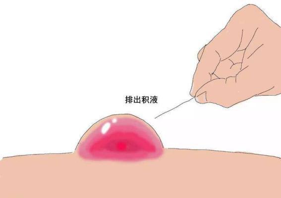 痛风脚底长水泡是什么原因,脚底疼肿是怎么回事