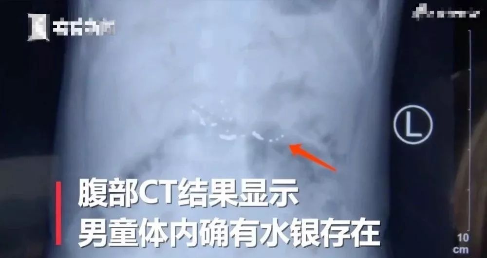 水银体温计摔碎后处理后如何消毒,体温计打碎了母女中毒死亡