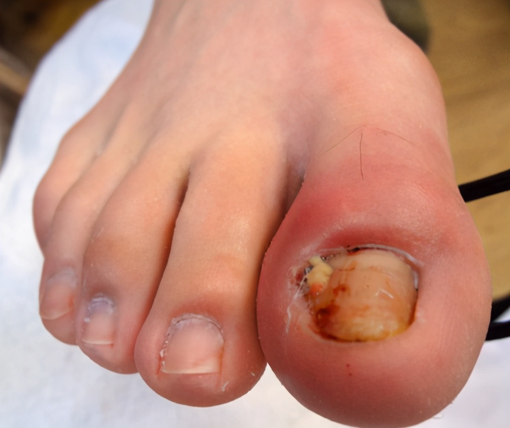 甲沟炎的处理方法视频,甲沟炎处理小视频