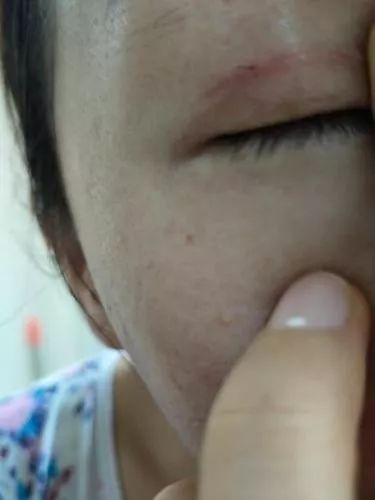女子双眼皮整容失败,女子整容后惨不忍睹