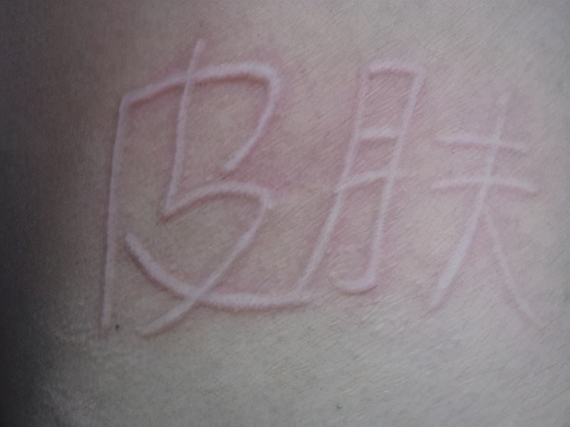 麻疹痒怎么缓解还有点晕,荨麻疹奇痒难耐该怎么办