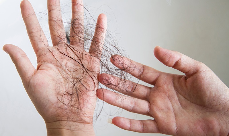 生姜擦头皮可以治疗脂溢性脱发吗,生姜对脂溢性脱发有用吗