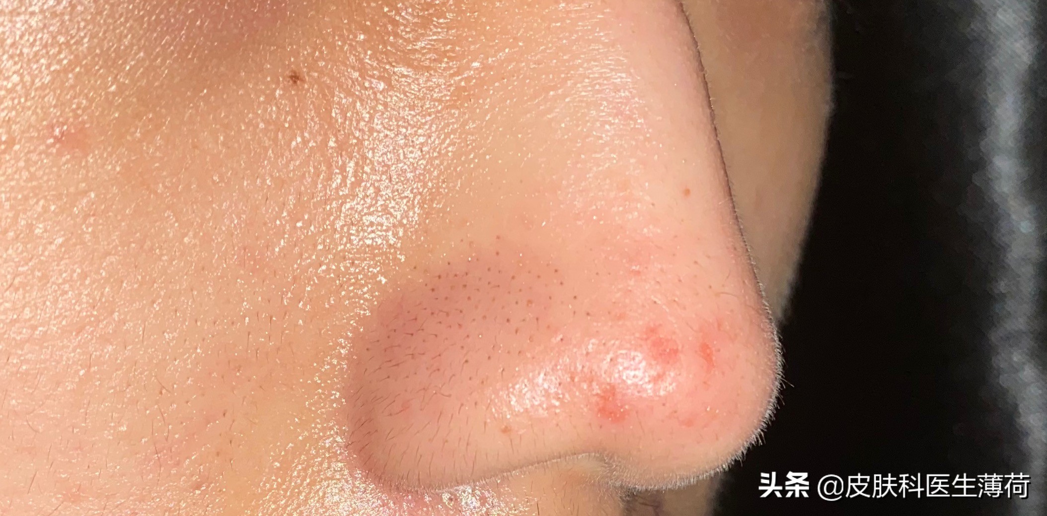 果酸换肤医生讲解,医生不会告诉你的秘密水杨酸