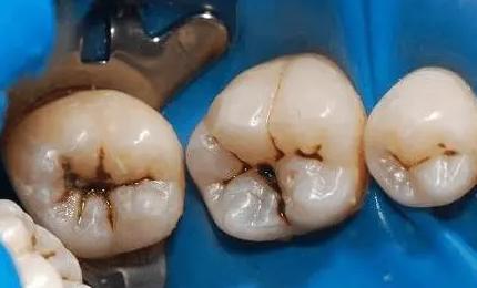 牙齿破损一小点什么原因,牙齿有小黑点医生不处理直接补上