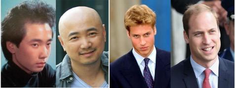 秃发前期头发的样子,斑秃脱发发根又细又白