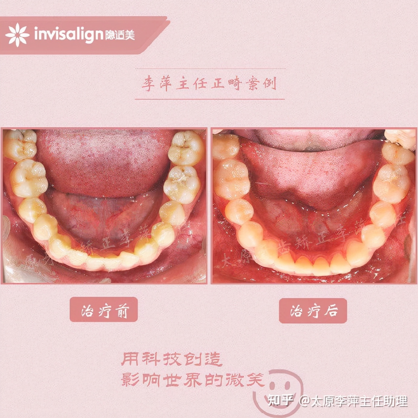 重度拥挤矫正牙齿适合隐形牙套吗,广州成人牙齿矫正推荐隐形牙套