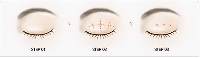 韩国新式双眼皮,韩国双眼皮手术全过程