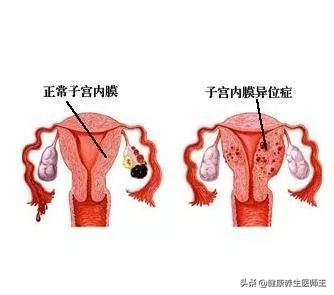 子宫内膜异位症试管,子宫内膜异位症