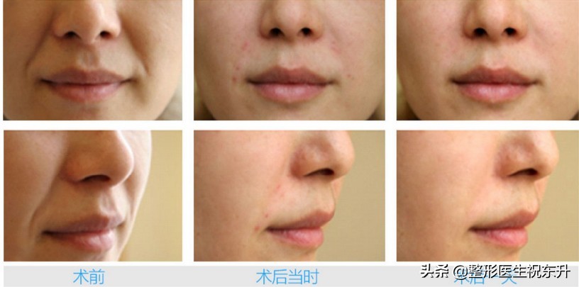 法令纹打玻尿酸还是做线雕效果好,线雕和玻尿酸祛除法令纹哪个好