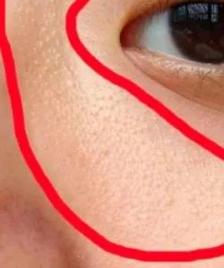 你长得真的是脂肪粒吗？如何解决“脂肪粒”？